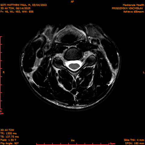 2025-06-14/3D AX T2W/0047-.png
