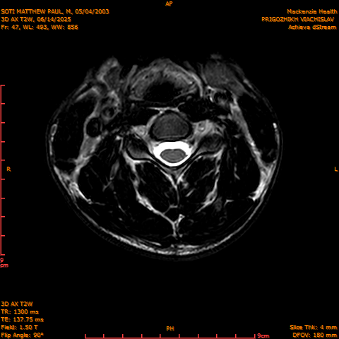 2025-06-14/3D AX T2W/0048-.png