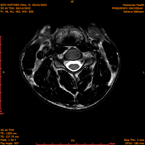 2025-06-14/3D AX T2W/0049-.png