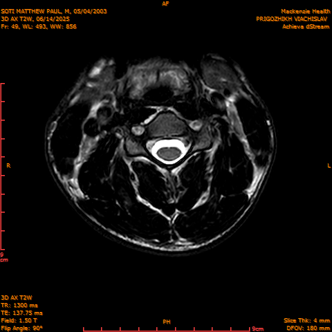 2025-06-14/3D AX T2W/0050-.png