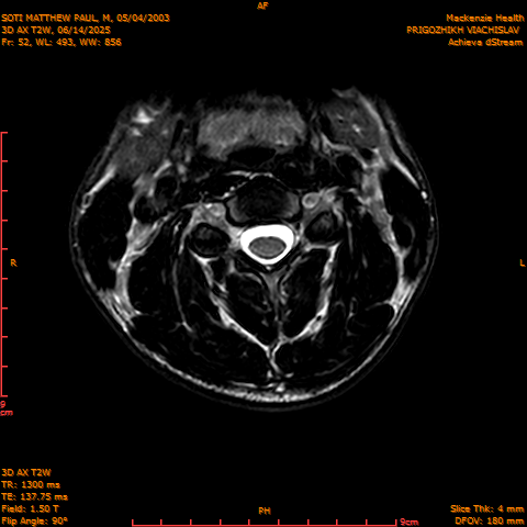 2025-06-14/3D AX T2W/0053-.png