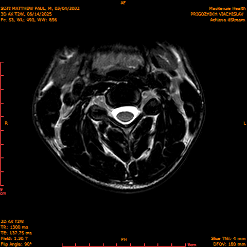 2025-06-14/3D AX T2W/0054-.png