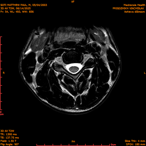 2025-06-14/3D AX T2W/0055-.png