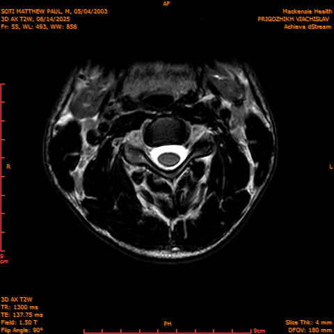 2025-06-14/3D AX T2W/0056-.png