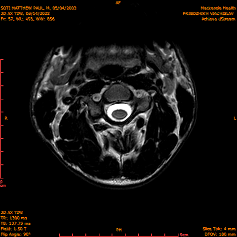 2025-06-14/3D AX T2W/0058-.png