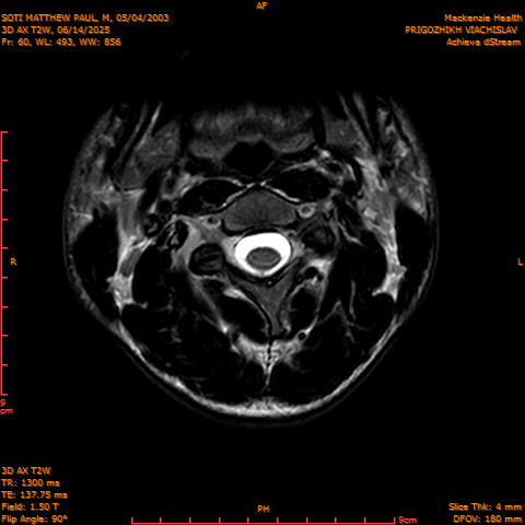 2025-06-14/3D AX T2W/0061-.png