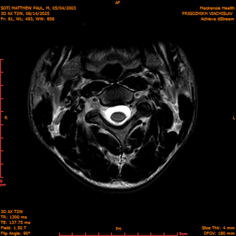 2025-06-14/3D AX T2W/0062-.png