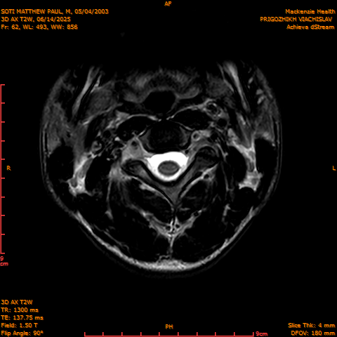 2025-06-14/3D AX T2W/0063-.png