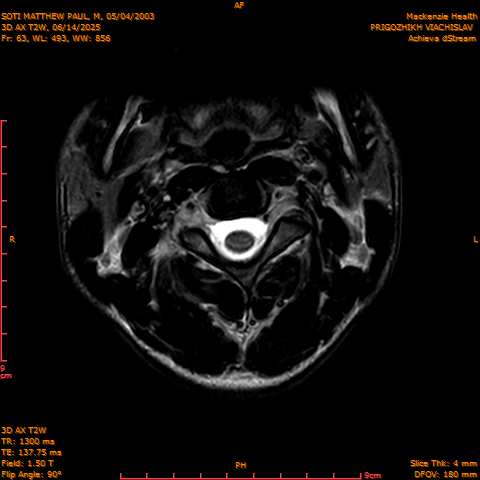 2025-06-14/3D AX T2W/0064-.png