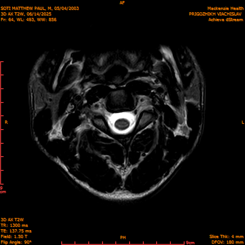 2025-06-14/3D AX T2W/0065-.png