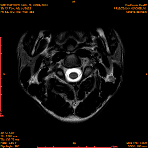 2025-06-14/3D AX T2W/0066-.png