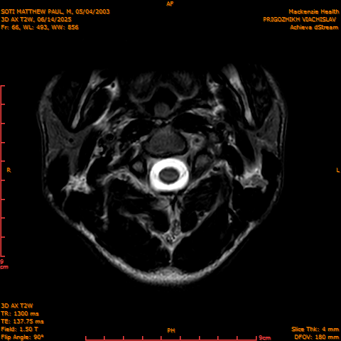 2025-06-14/3D AX T2W/0067-.png