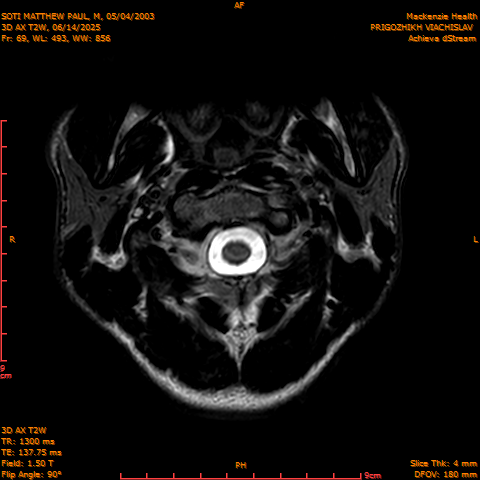 2025-06-14/3D AX T2W/0070-.png