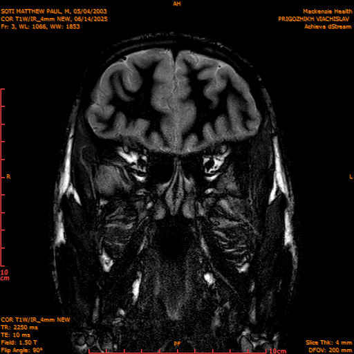 2025-06-14/COR T1W-IR_4mm NEW/0004-IM995.png