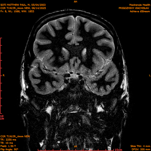 2025-06-14/COR T1W-IR_4mm NEW/0009-IM1000.png
