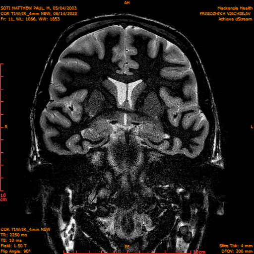 2025-06-14/COR T1W-IR_4mm NEW/0012-IM1003.png