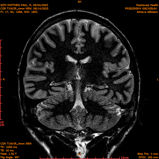 2025-06-14/COR T1W-IR_4mm NEW/0018-IM1009.png