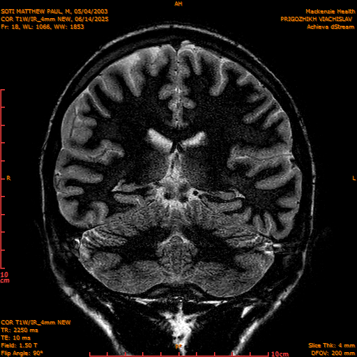 2025-06-14/COR T1W-IR_4mm NEW/0019-IM1010.png