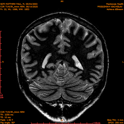 2025-06-14/COR T1W-IR_4mm NEW/0023-IM1014.png
