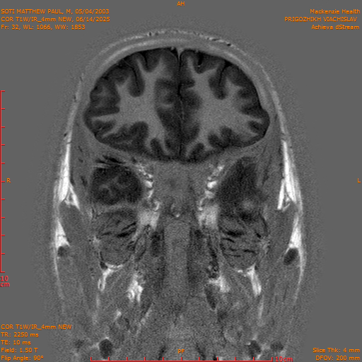 2025-06-14/COR T1W-IR_4mm NEW/0033-IM1024.png