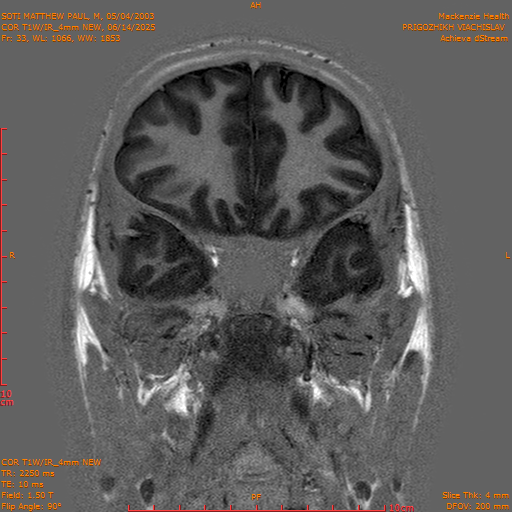 2025-06-14/COR T1W-IR_4mm NEW/0034-IM1025.png