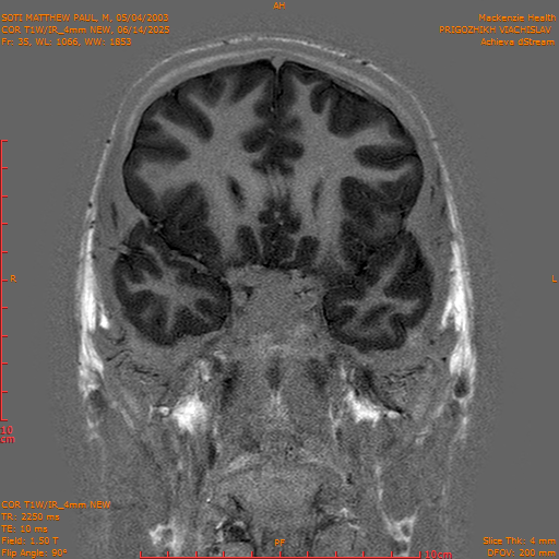 2025-06-14/COR T1W-IR_4mm NEW/0036-IM1027.png