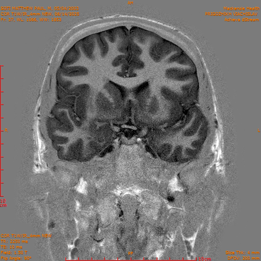 2025-06-14/COR T1W-IR_4mm NEW/0038-IM1029.png