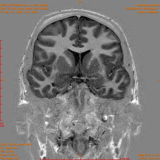 2025-06-14/COR T1W-IR_4mm NEW/0039-IM1030.png