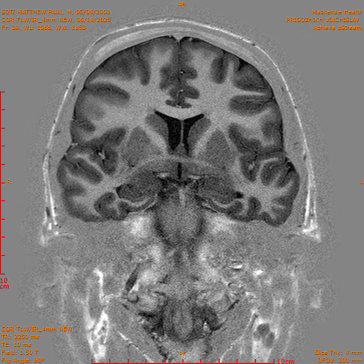 2025-06-14/COR T1W-IR_4mm NEW/0040-IM1031.png