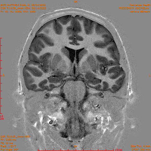 2025-06-14/COR T1W-IR_4mm NEW/0041-IM1032.png