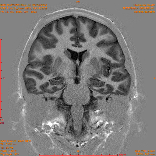 2025-06-14/COR T1W-IR_4mm NEW/0042-IM1033.png
