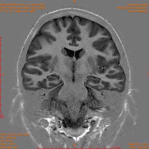 2025-06-14/COR T1W-IR_4mm NEW/0043-IM1034.png