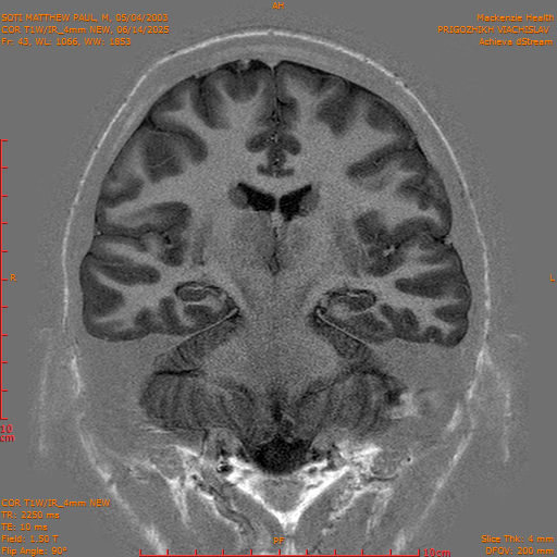 2025-06-14/COR T1W-IR_4mm NEW/0044-IM1035.png