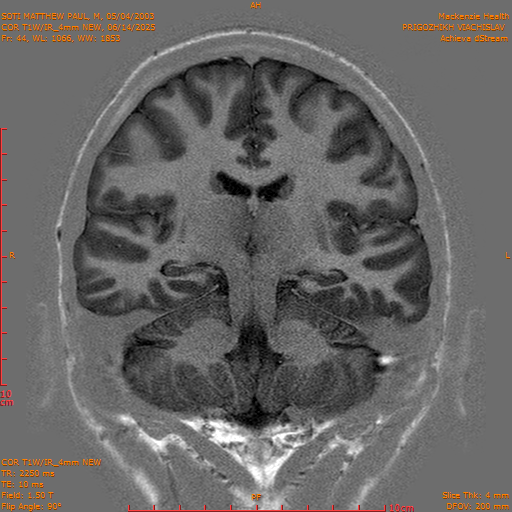 2025-06-14/COR T1W-IR_4mm NEW/0045-IM1036.png
