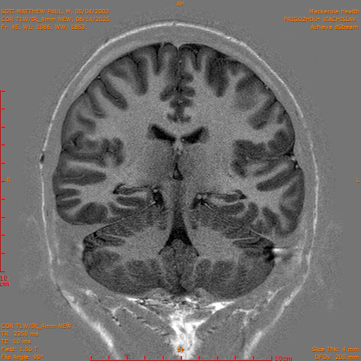 2025-06-14/COR T1W-IR_4mm NEW/0046-IM1037.png