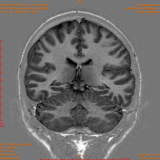 2025-06-14/COR T1W-IR_4mm NEW/0047-IM1038.png