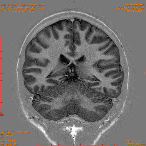 2025-06-14/COR T1W-IR_4mm NEW/0048-IM1039.png