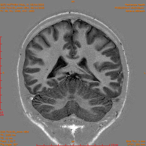 2025-06-14/COR T1W-IR_4mm NEW/0049-IM1040.png