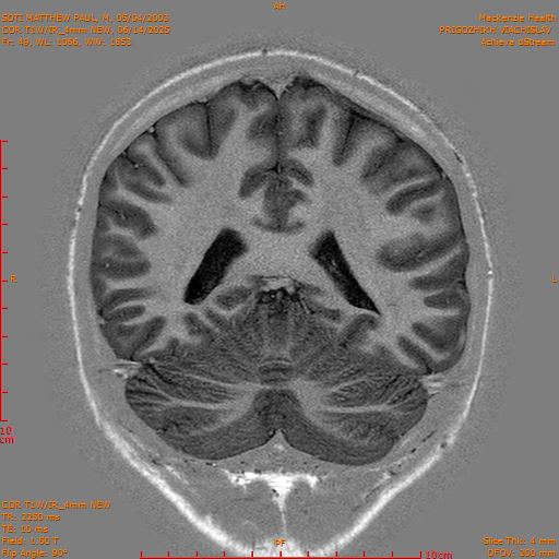 2025-06-14/COR T1W-IR_4mm NEW/0050-IM1041.png