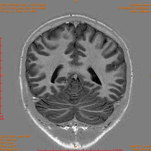 2025-06-14/COR T1W-IR_4mm NEW/0051-IM1042.png