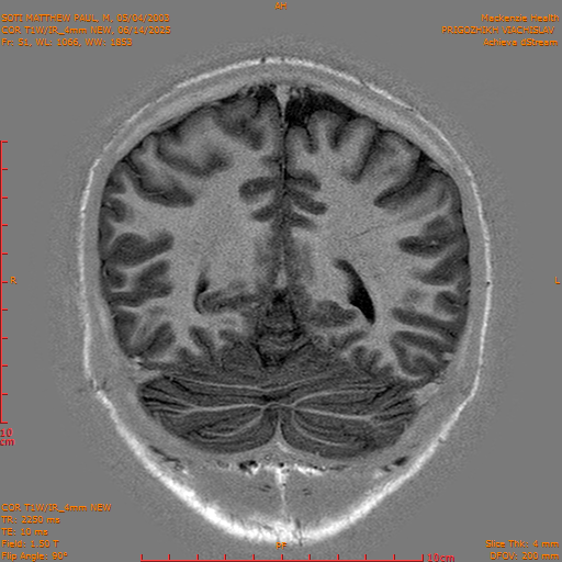 2025-06-14/COR T1W-IR_4mm NEW/0052-IM1043.png