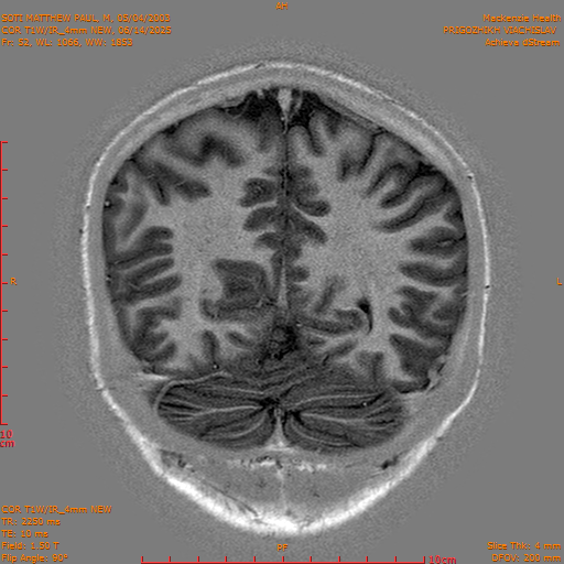 2025-06-14/COR T1W-IR_4mm NEW/0053-IM1044.png