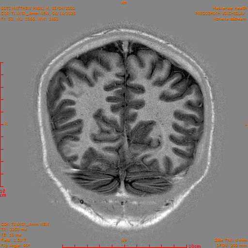 2025-06-14/COR T1W-IR_4mm NEW/0054-IM1045.png