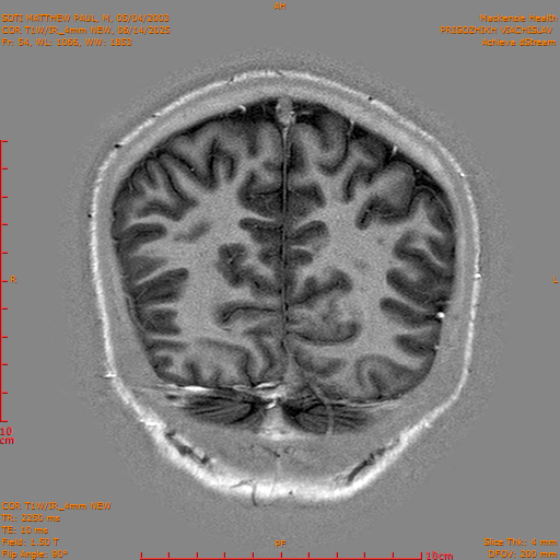 2025-06-14/COR T1W-IR_4mm NEW/0055-IM1046.png