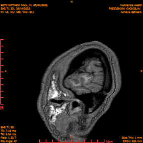 2025-06-14/SAG T1 3D/0016-IM201.png