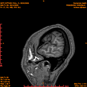 2025-06-14/SAG T1 3D/0018-IM203.png