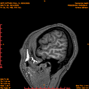 2025-06-14/SAG T1 3D/0021-IM206.png