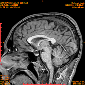 2025-06-14/SAG T1 3D/0079-IM264.png
