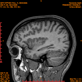 2025-06-14/SAG T1 3D/0115-IM300.png