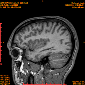 2025-06-14/SAG T1 3D/0116-IM301.png